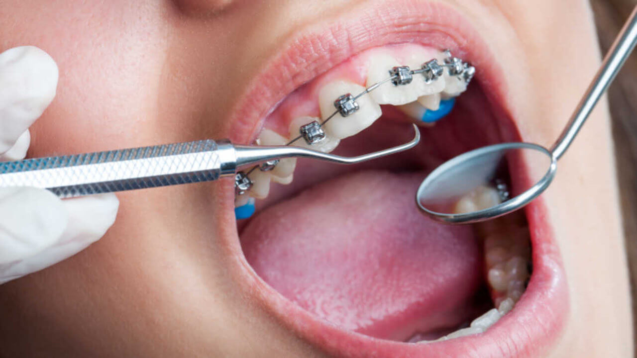 Orthodontics in Preston, Victoria. Melbourne - Chic Dental